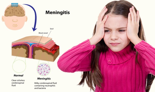 meningite-em-criancas